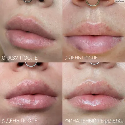 Как выглядят увеличенные губы после введения 1 миллилитра филлера:  наглядный пример для тех, кто хочет попробовать уколы красоты