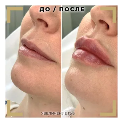 Увеличение губ гиалуроновой кислотой в Кишиневе и Харькове - фото до и  после |Honest Beauty