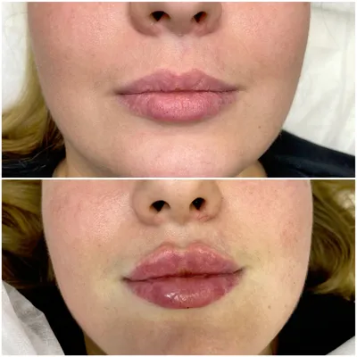 Увеличение губ Juvederm - «Увеличила губы впервые на 0,5 мл. ЦЕНА, Фото  до/после» | отзывы