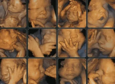Камэк Узи отделение - Снимки при УЗИ 📸 и снимки при 3D УЗИ📸 ...разница  колоссальная🔥👏 Расскажу немного о процессе: Фотографии малыша (при  стандартном чёрно-белом режиме-2D) в 3 разных проекциях накладываются друг  на