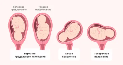 Плановые роды до 39 недель: Стоит ли это делать? - Иркутский городской  перинатальный центр имени Малиновского М.С.