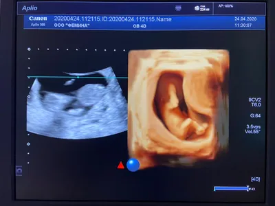 3D и 4D УЗИ при беременности в Москве – цены в медицинском центре «За  Рождение»