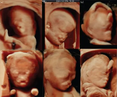 Для чего нужно 3D УЗИ при беременности? | Беременность и роды - YouTube