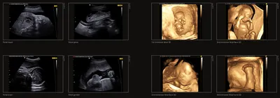 3D/4D УЗИ при беременности - цена скрининга | Центр медицины плода