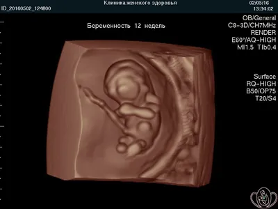 3D УЗИ при беременности в СПб