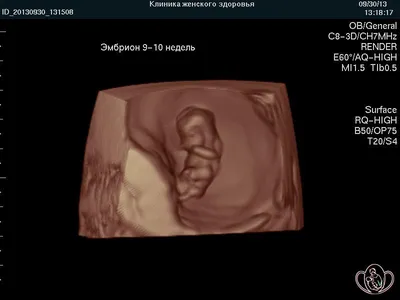 3D УЗИ и 25 недель — 2 ответов | форум Babyblog