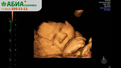 4D УЗИ во время беременности - «3D/4D УЗИ помогло выявить патологию и  вовремя предпринять все необходимые меры (фото для сравнения)» | отзывы