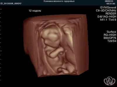 3D и 4D УЗИ при беременности | За Рождение | Дзен