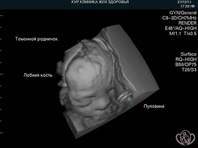 Фотографии 4d Узи Ребенка В Утробе Матери Коллаж Из 3dизображений Эхографии  — стоковые фотографии и другие картинки Ультразвуковая диагностика - iStock