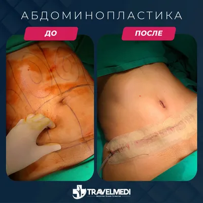 Фотографии до/после операции