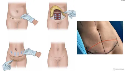 Абдоминопластика (подтяжка живота) - «ДНЕВНИК Мини Абдоминопластики без  переноса пупка» | отзывы
