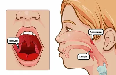 Операция по удалению аденоидов у детей: как проходит и что нужно знать