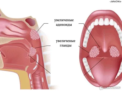 Эндоскопия носоглотки - «Как смотрят аденоиды ребенку, долго ли это и  больно ли смотреть эндоскопом. Три степени развития аденоидов. » | отзывы