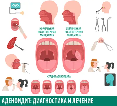 Острый аденоидит у ребенка. Лечение - статьи от компании Еламед