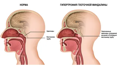 Аденоиды у детей: симтомы, диагностика, лечение | Клиника Эксперт