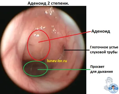 Аденоиды - фото - ЛОР в Самаре - врач Лунёв Андрей Владимирович