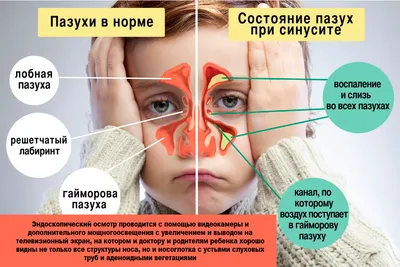 Аденоиды: удалить или сохранить - Новости поликлиники