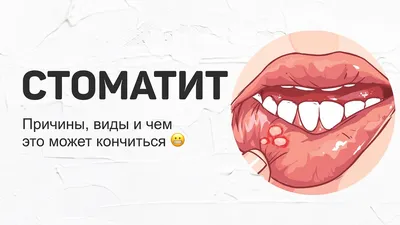 Афтозный стоматит – что это, лечение, виды, причины и симптомы