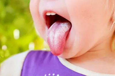 Афтозный стоматит у детей | TopDent | Дзен