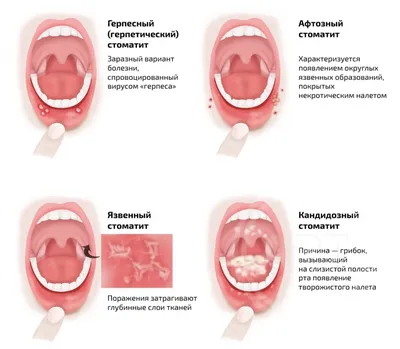 Афтозный стоматит: причины, симптомы и лечение