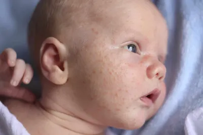 Акне новорожденных и все, что необходимо знать об этом — Allergika  (Аллергика) Украина