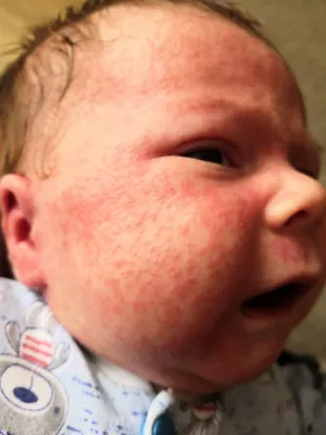 Акне или аллергия у младенца - Вопрос дерматологу - 03 Онлайн