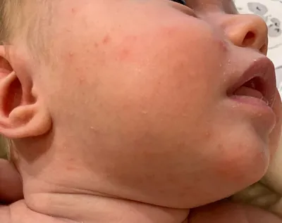 Потница, акне новорожденных или аллергия? — 16 ответов | форум Babyblog