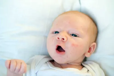 Акне новорожденных: симптомы, лечение и возможные осложнения
