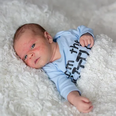 Акне у новорожденных: как отличить от аллергии | EVA Blog