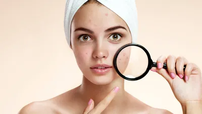 Лечение акне (угрей) в Киеве | Brenner Clinic