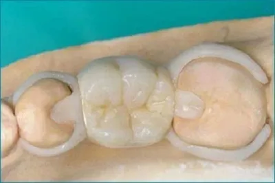 Акриловые зубные протезы: виды и преимущества