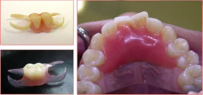 Зубной Акриловый Протез Зубов Какой Выбрать ЛюмиДент