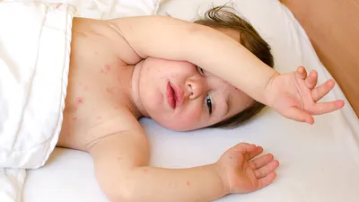 Аллергическая сыпь у ребенка фотографии