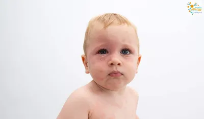 Аллергическая сыпь у ребенка фотографии