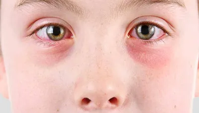 Аллергия на глазах у ребенка фото фотографии