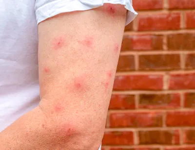 Аллергия на пылевого клеща: симптомы и лечение