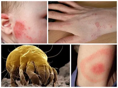 Аллергия на укусы клопов у детей и взрослых: как выглядит и чем лечить