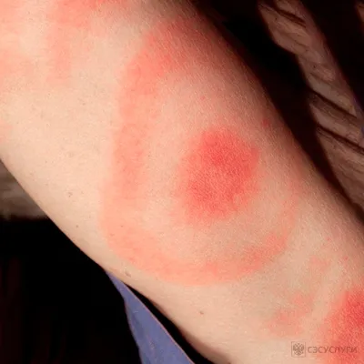 Аллергическая реакция на укусы постельных клопов