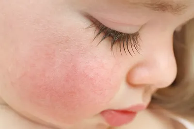 Пищевая аллергия у детей. Как проявляется и как лечить?
