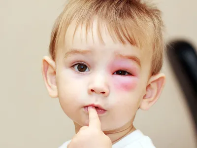 Аллергический отек век у ребенка - энциклопедия Ochkov.net