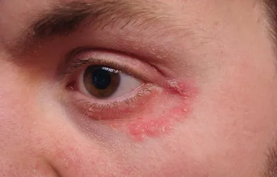 Аллергия на глазах у ребенка - фото, лечение, причины и симптомы
