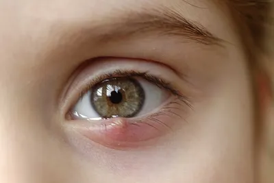 Капли для глаз от аллергии для детей и взрослых | Мегаптека