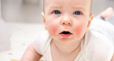 Закисает глаз у новорожденного: причины и решение | Nestle Baby