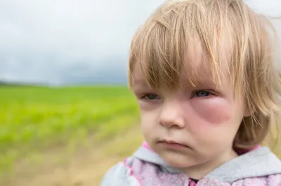 Аллергия Глаза Веки – Telegraph