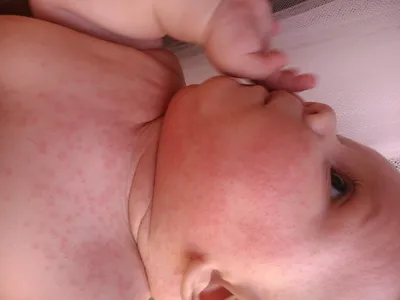 Аллергическая сыпь на коже у детей грудного возраста