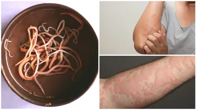 Аллергия от глистов и других паразитов у детей и взрослых