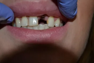 Лечение альвеолита после удаления зуба в Москве — стоматология «Один к  одному» на Войковской