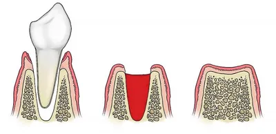 Лечение альвеолита лунки после удаления зуба в Москве - клиника Медведева