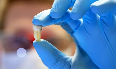 Альвеолит после удаления зуба: причины возникновения, симптомы и лечение