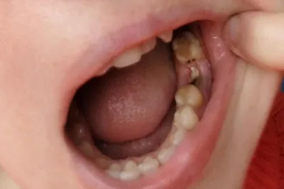 Нормально ли выглядит лунка зуба или это альвеолит? - Хирургия - Форум  стоматологов (стомотологический форум) - Профессиональный стоматологический  портал (сайт) «Клуб стоматологов»